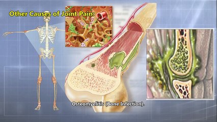 What Can Cause Joint Pain and How is It Treated?