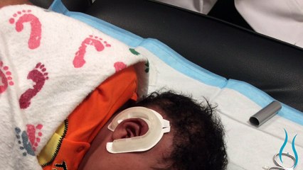 Infant Ear Molding for Newborn Ear Deformities