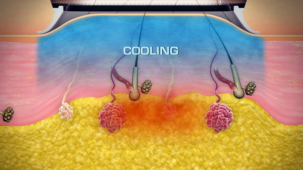 miraDry Testimonial for Excessive Underarm Sweating