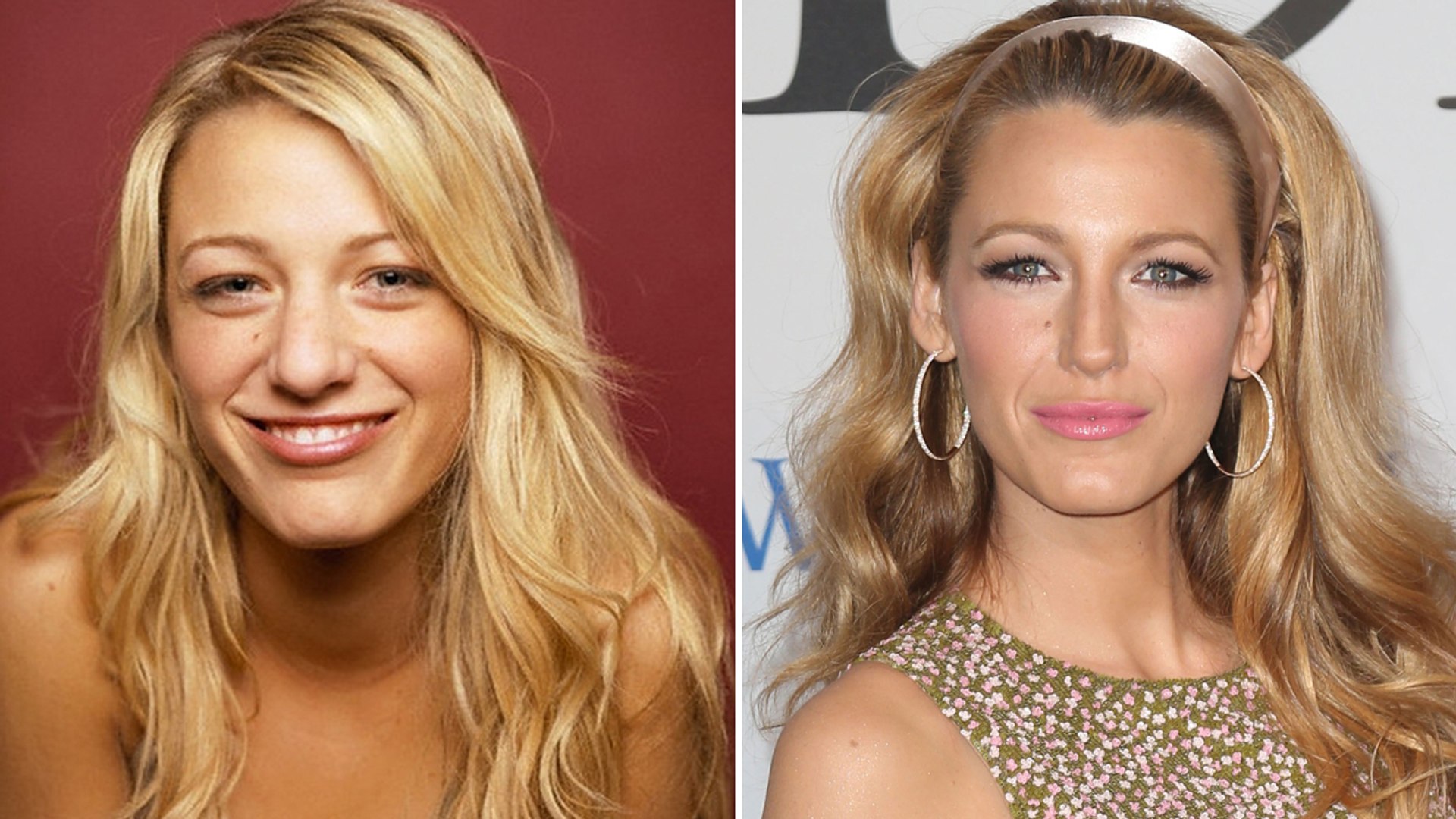 Blake Lively Plastic Surgery video Dailymotion