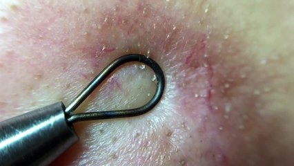 角栓29.1 （Farsightedness version）nose blackheads