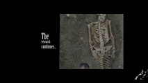 Real Mermaid Skeleton Found | Sirenomelia |The mermaid syndrome