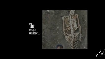 Real Mermaid Skeleton Found | Sirenomelia |The mermaid syndrome