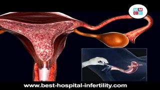 HSG Procedure Tamil Nadu - Fertility Clinic in Erode