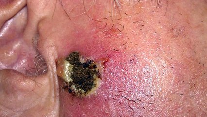 Skin Cancer victory - Part 2 - Cansema Black Salve