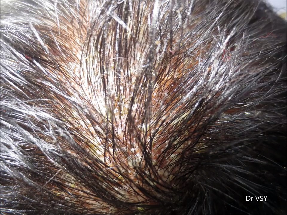 Pustules On Scalp