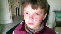 FNN Syria Aleppo al-Mashed a child infected with Leishmaniasis skin 29-1-2013 (very effective) 21+