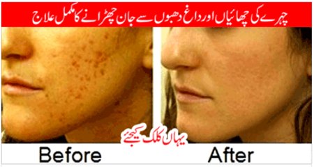 How to Remove Pimples or Acne