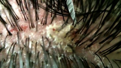 【フケpart7】毛穴たくさんグロテスクなフケgross !! I peeled off the pores of many dandruff.