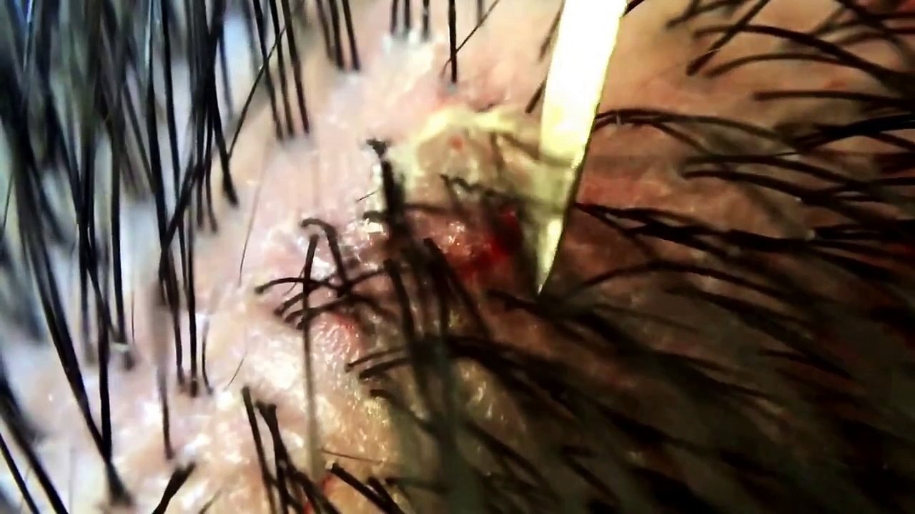 【フケpart26】大きなフケが剥けました。 閲覧注意 Large dandruff was peel. View is attention.