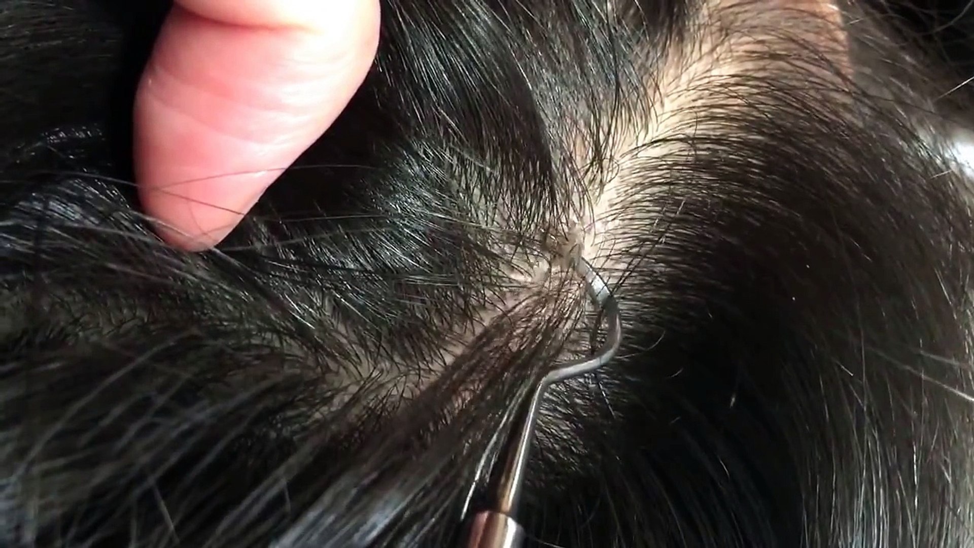 フケpart1 スッキリ日焼け後頭皮のフケむきstripped Dandruff Video Dailymotion