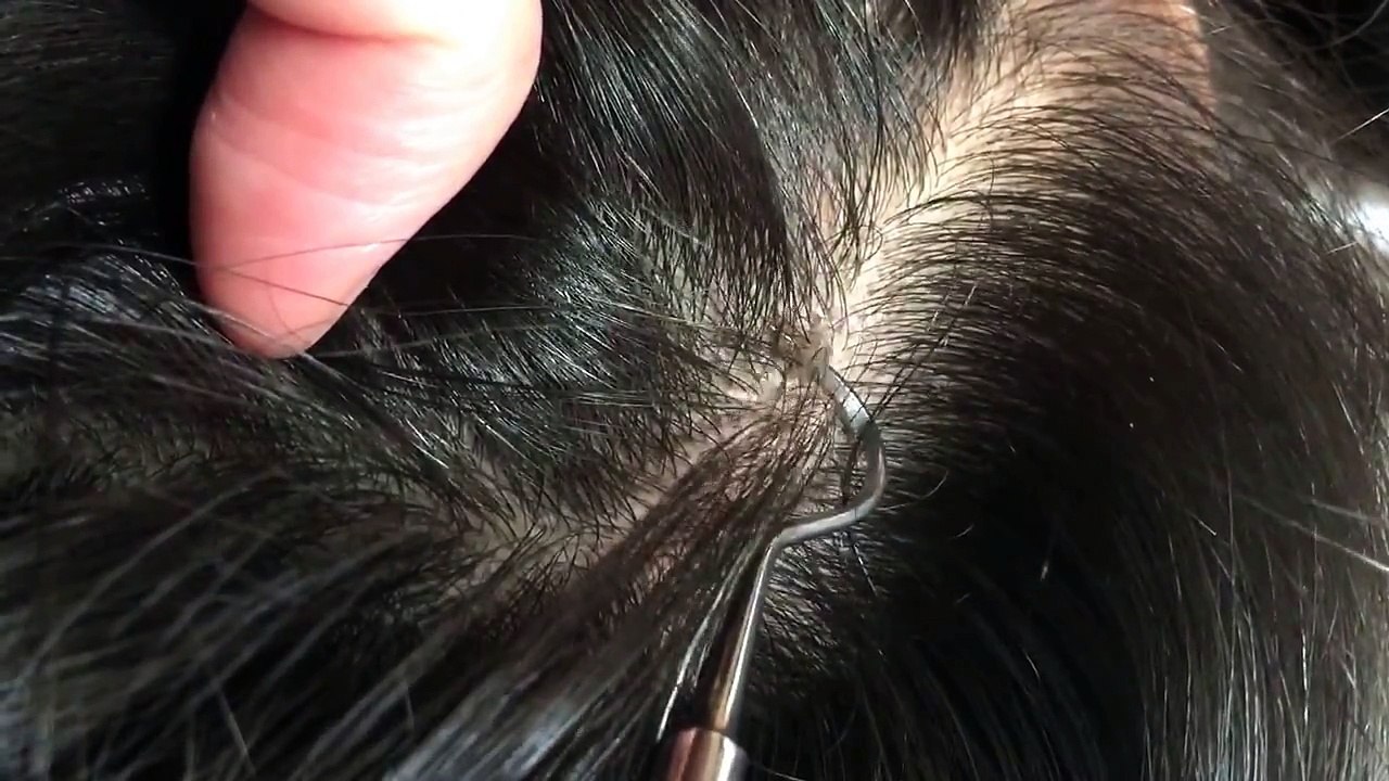 【フケpart1】スッキリ日焼け後頭皮のフケむきstripped dandruff.