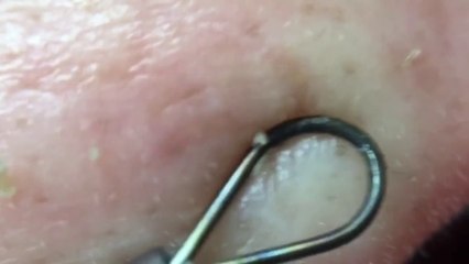 角栓28.1 （Farsightedness version）nose blackheads