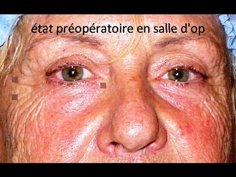 ptosis avant après par vladimr mitz