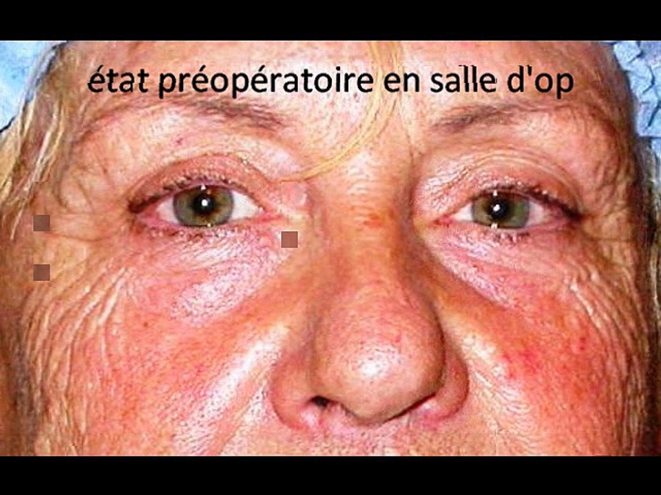 ptosis avant après par vladimr mitz