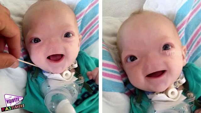 This Baby Was Born Without Nose, So Cute!