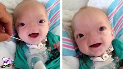 This Baby Was Born Without Nose, So Cute!
