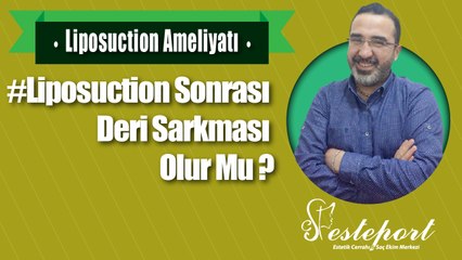 Liposuction Deri Sarkmasına Neden Olur Mu ?
