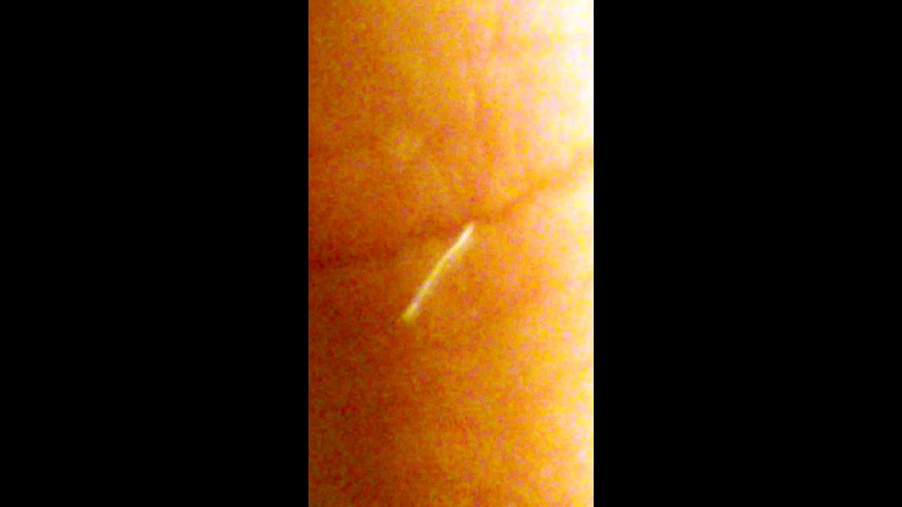 [REQUESTED] Worm? Fiber? Morgellons? Exiting the Skin (Thumb) Parasite Cleanse