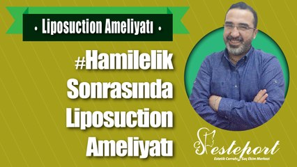 Hamilelik Sonrası Liposuction ile Yağ Alma