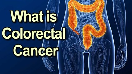 What Is Colorectal Cancer? How Does Colorectal Cancer Start? || Cancer Tips