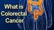 What Is Colorectal Cancer? How Does Colorectal Cancer Start? || Cancer Tips