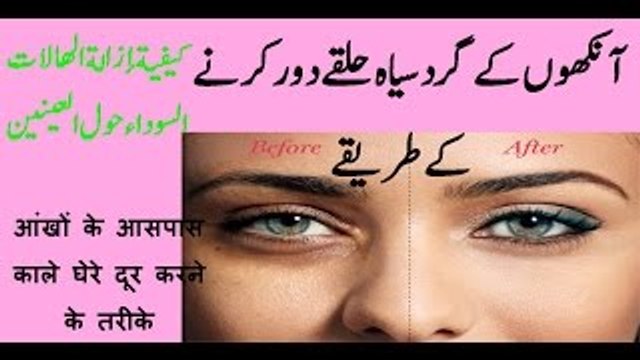 Aankhon Ke Gird Siyah Halke (Dark Circles)