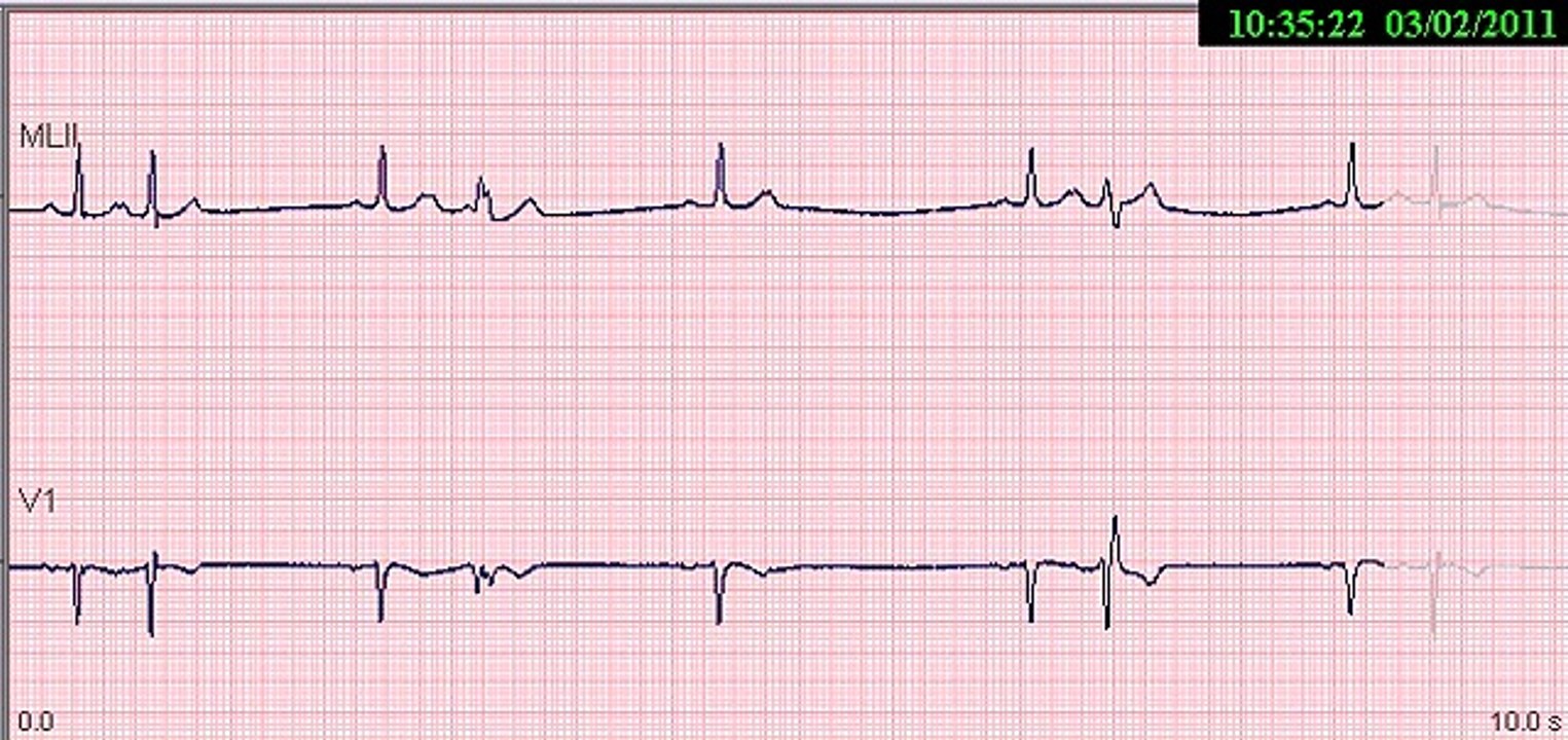 05-EKG-COMPLEXO ATRIAL PREMATURO