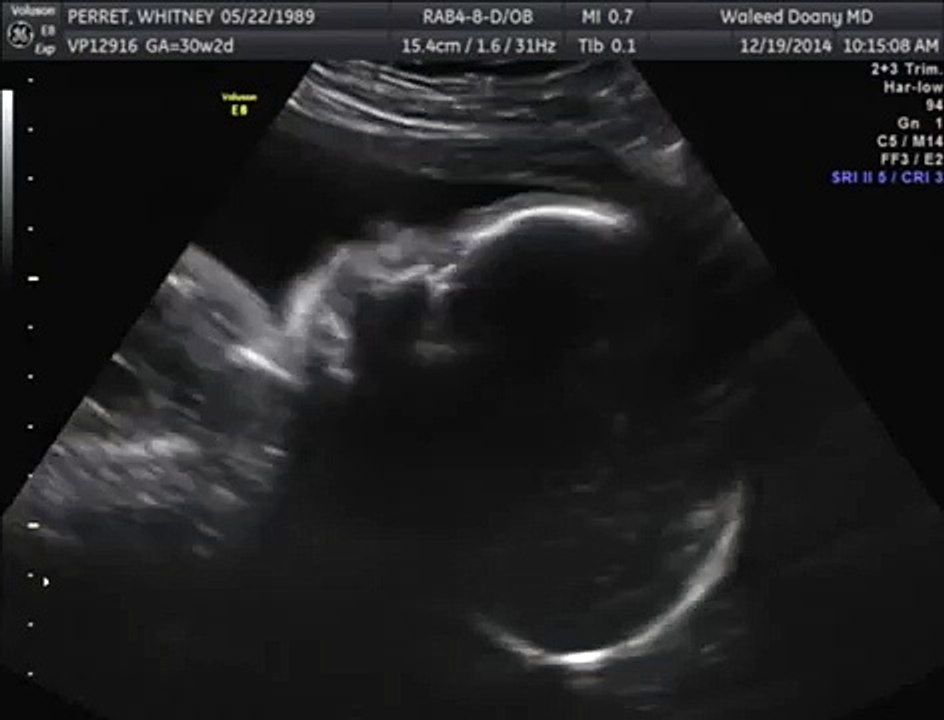 Baby yawning in the womb!