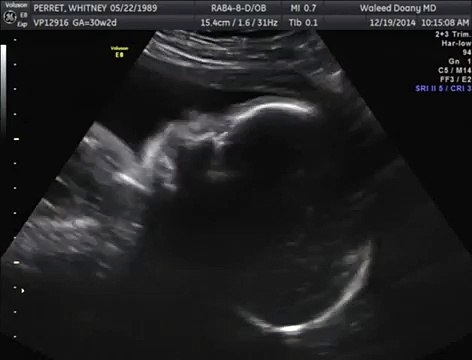 Baby yawning in the womb!