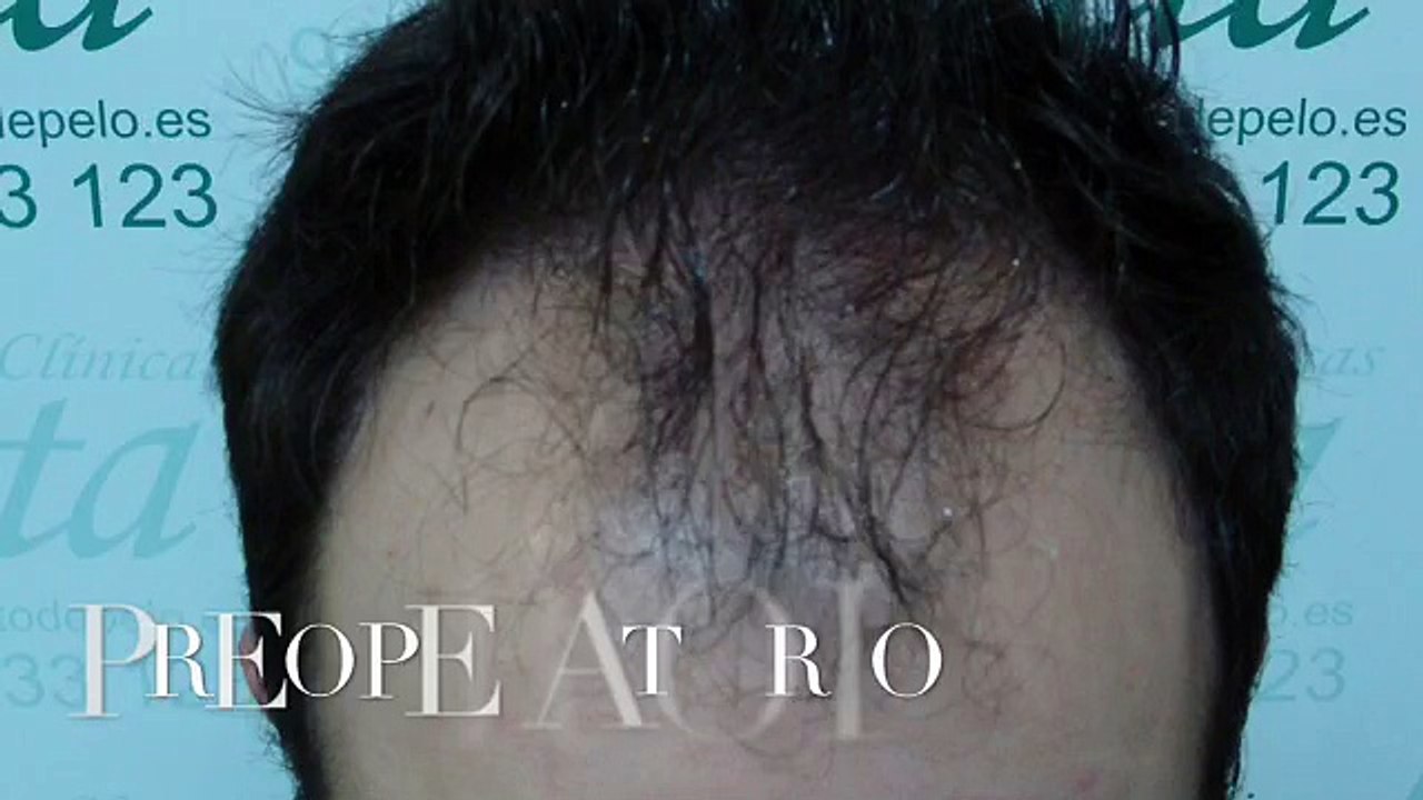 CLINICAS CETA CAPITAL www.injertodepelo.es