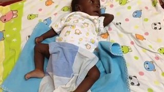 Baby boy with eight limbs progressing well after successful operation!!