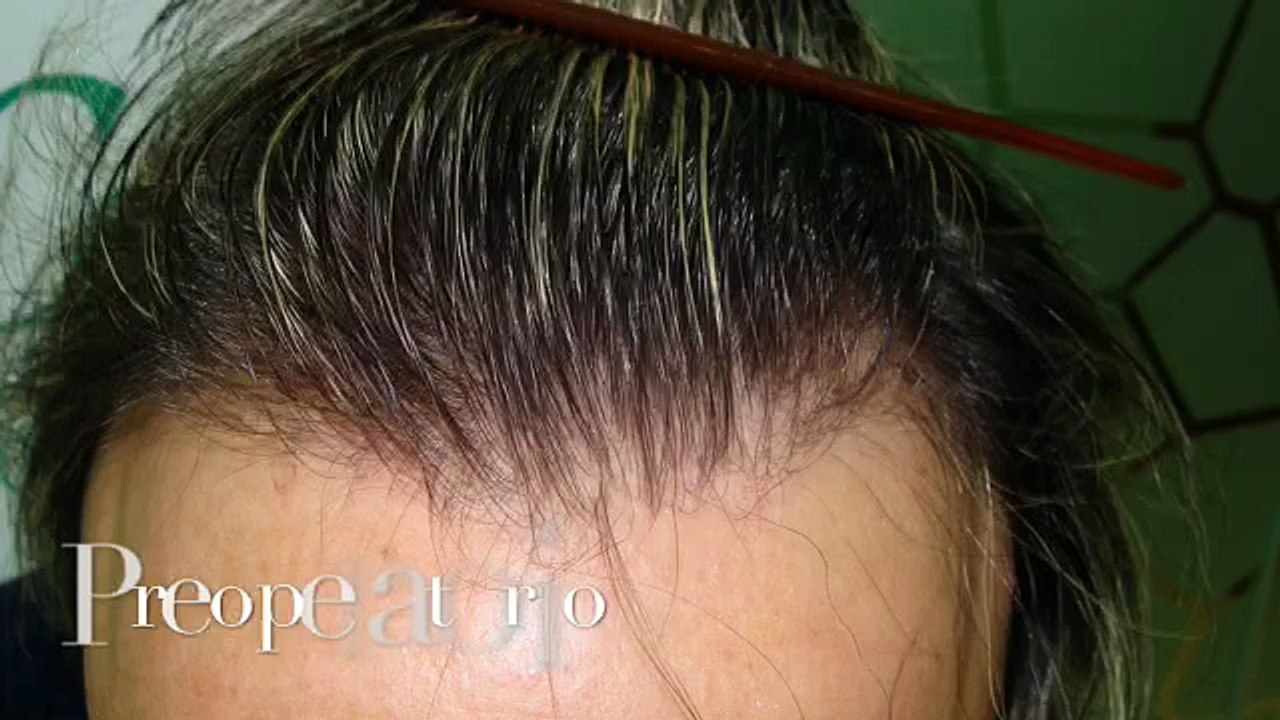 CLINICAS CETA CAPITAL www.injertodepelo.es