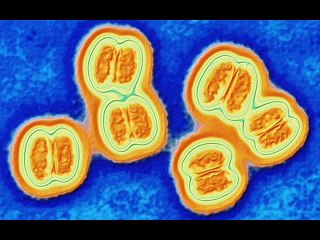 NEWBORN BABY INFECTIONS 7 & MENINGITIS