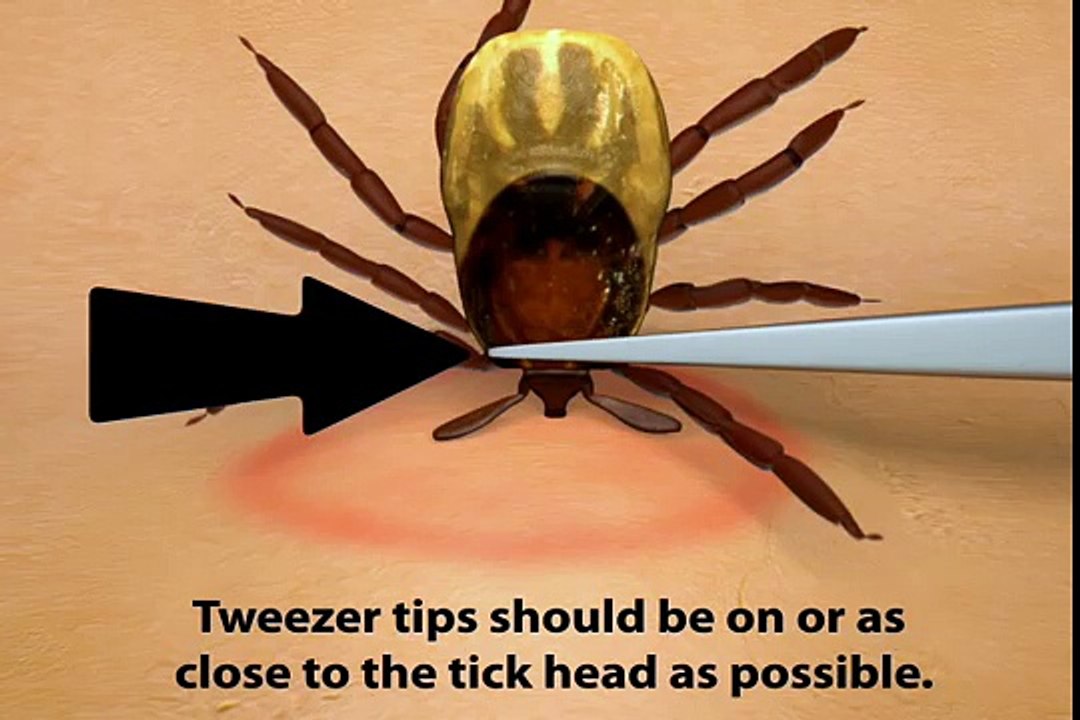 How To Remove A Tick