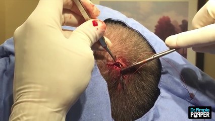 Is this a cyst on the scalp? To be continued...