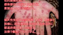 【閲覧注意】日本で近年増加している「梅毒(感染病)」患者の末期の症状がヤバすぎる・・・