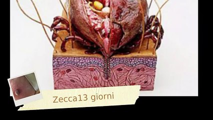 Zecca Viva nella gamba per 13 giorni -estrazione-