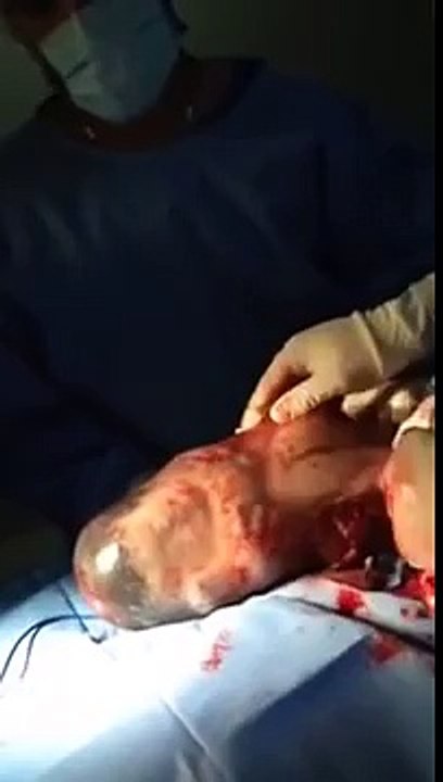 Medical curiosity : a new born baby is comfortably born to the world inside his amniotic sac out of the mother’s belly