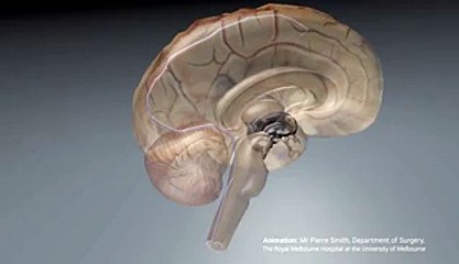 Un implant cérébral pourrait faire remarcher les personnes paralysées