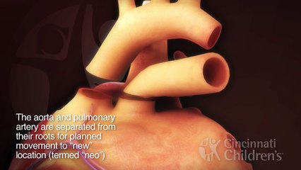 Arterial Switch Operation for Transposition of the Great Arteries | Cincinnati Childrens v
