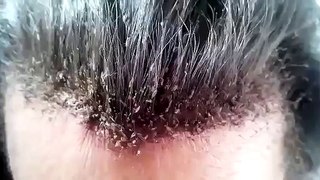 This Head Lice Infestation Is Unbelievable