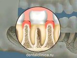 European Clinic of Aesthetic Dentistry in Budapest Jewel Dental AVANTE Лечение зубов имплантация