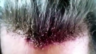 Horrible Video: The Worst Head Lice in the World