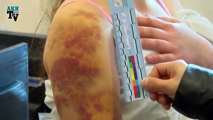 17 летняя Назбийке сбежала в Бишкек после избиений родной матерью и отчимом в Жалал Абаде