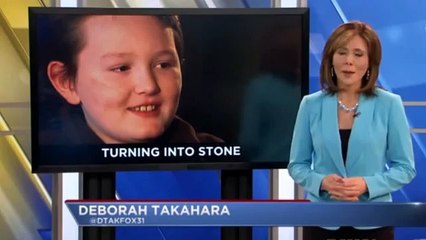 Rare illness could turn Colorado boy into STONE   Daily Mail Online (News World)