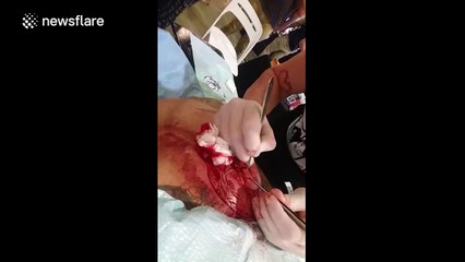 Man gets heart shape scarified onto his chest