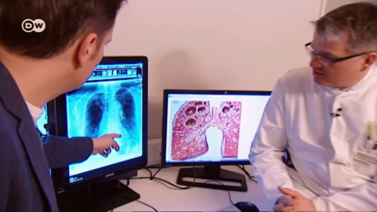 Tuberkulose richtig erkennen | Fit & Gesund