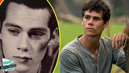 Dylan O'Brien Injured On Maze Runner Set