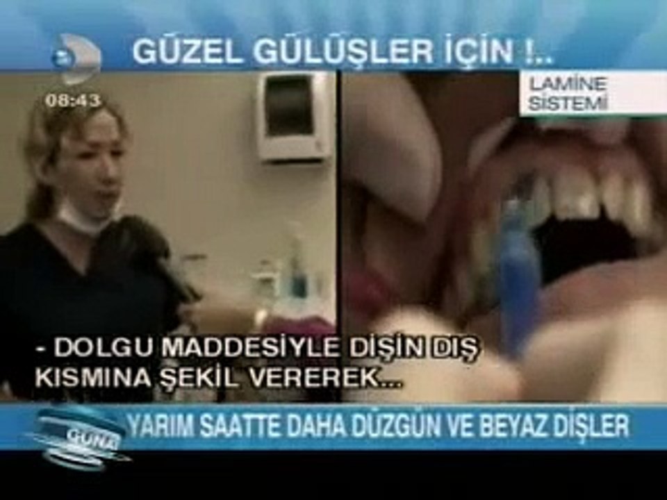 lamina diş tedavisi kaplama yapımı fiyatları nedir nasıl yapılır bembeyaz beyaz dişler için ne